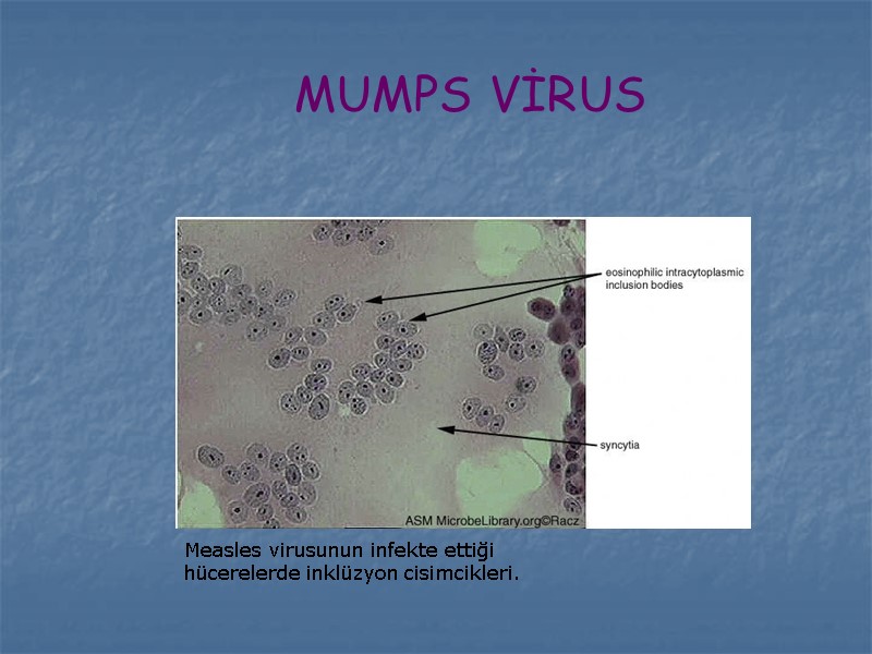 MUMPS VİRUS Measles virusunun infekte ettiği hücerelerde inklüzyon cisimcikleri.